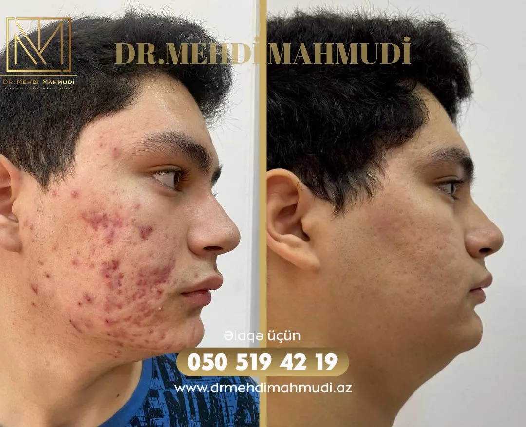 Çapıq - Xəstə6 - Kosmetik Dermatoloq Akne Klinik